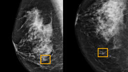 Kunstig intelligens bedre til at opdage brystkræft end britiske og amerikanske læger 